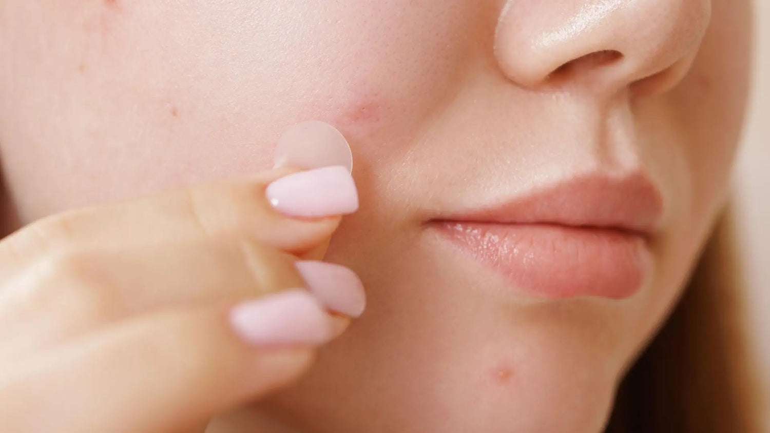 Do Pimple Patches Actually Work? Here’s Why Hydrocolloid Acne Patches Are So Popular