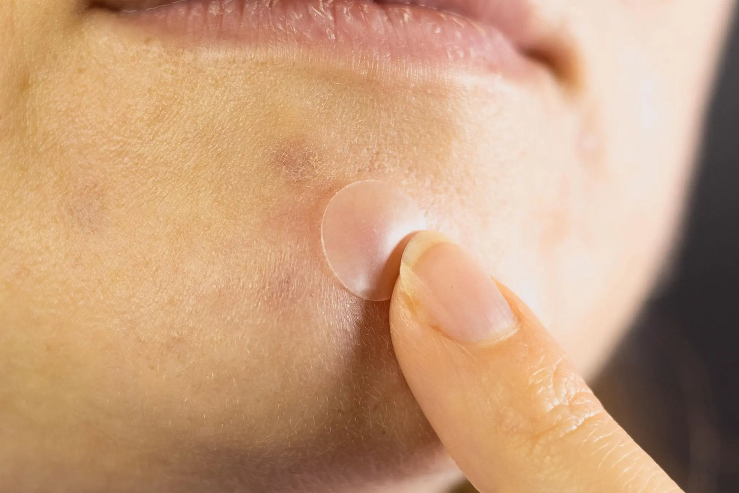 How Overnight Pimple Patches Help Reduce Redness & Dark Spots