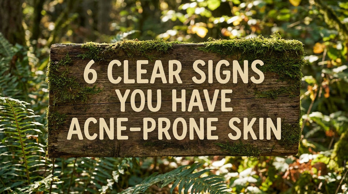 6 Clear Signs You Have Acne-Prone Skin (And How to Treat It Fast)