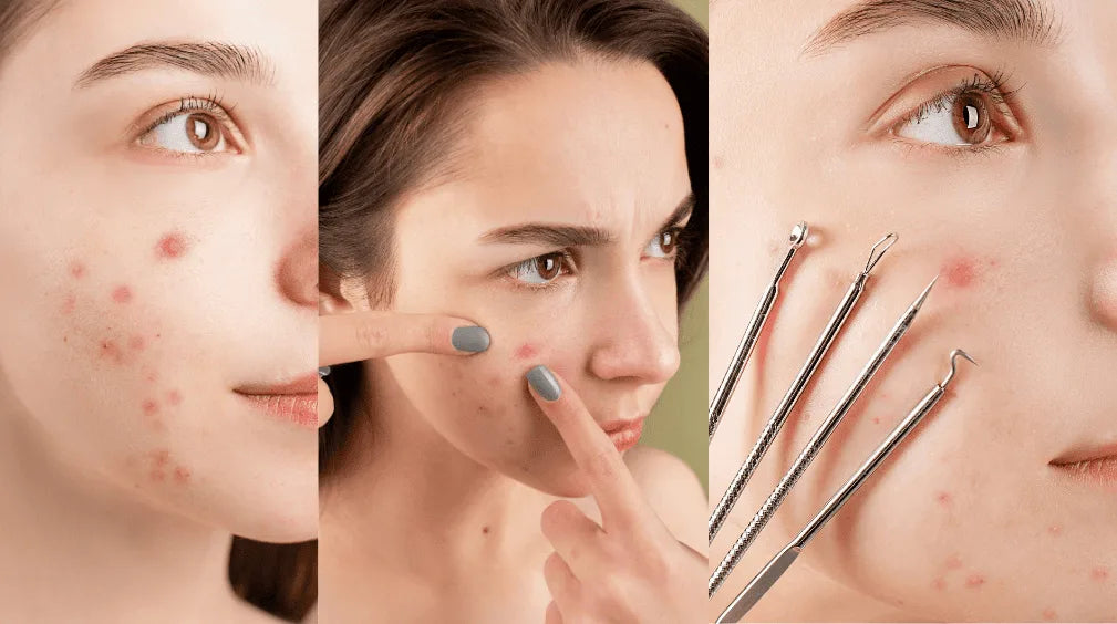 What To Do If a Pimple Starts Bleeding