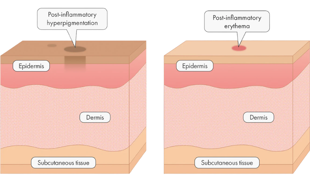 PIE vs PIH – Understanding Post-Acne Marks