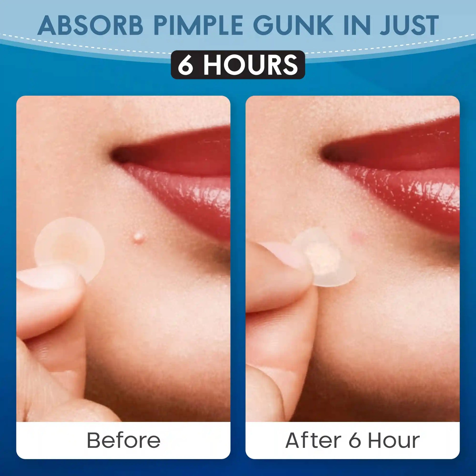 Before and after using Zovira Invisible pimple patch — absorbs pimple gunk and flattens blemish in just 6 hours

