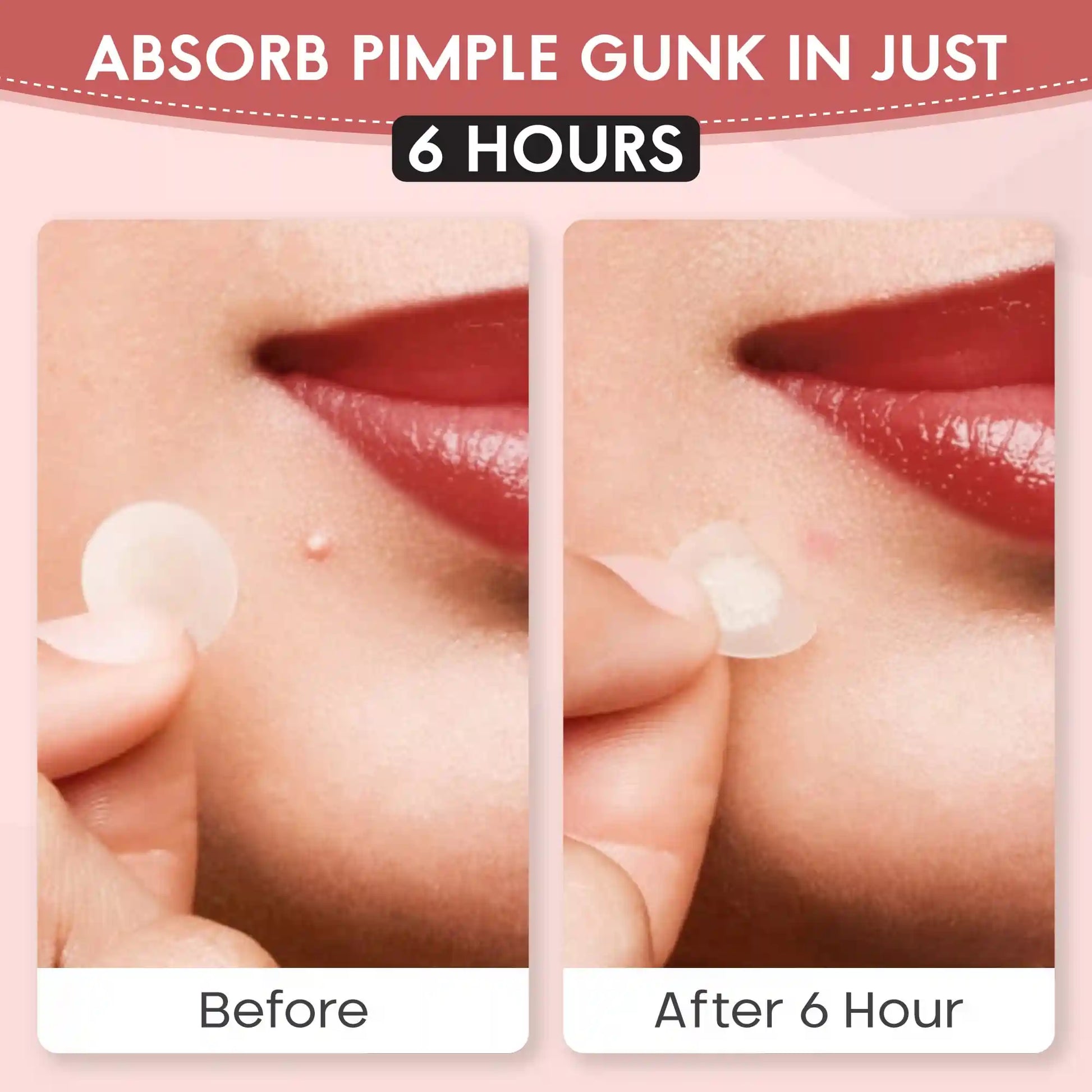 Before and after using Zovira pimple patch — absorbs pimple gunk and flattens blemish in just 6 hours

