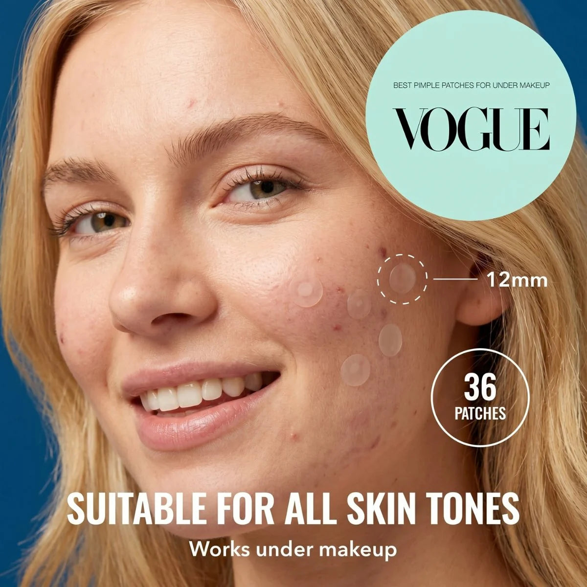 Blonde woman with Zovira 12mm hydrocolloid patches on acne-prone cheek - Suitable for all skin tones, works under makeup, featured in Vogue