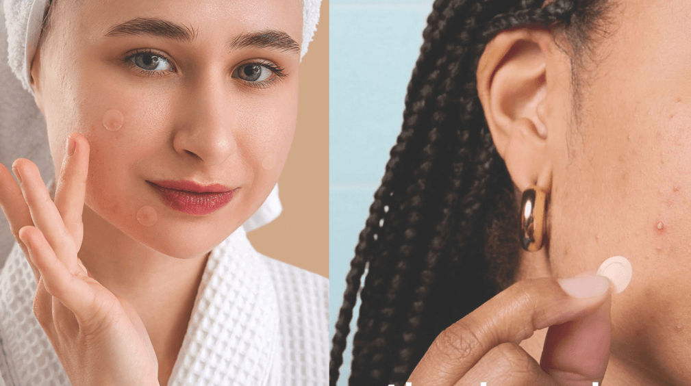 Women using acne patches for skincare routine. Clear skin treatment with hydrocolloid patches.