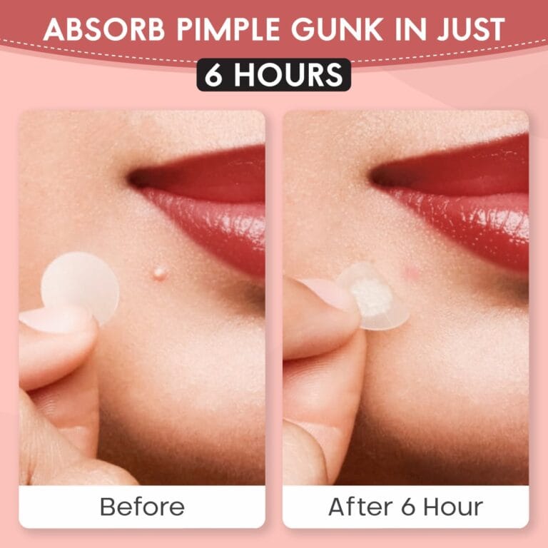 Zovira Original Acne patch before and after: absorbs blemish in 6 hours for clear skin.