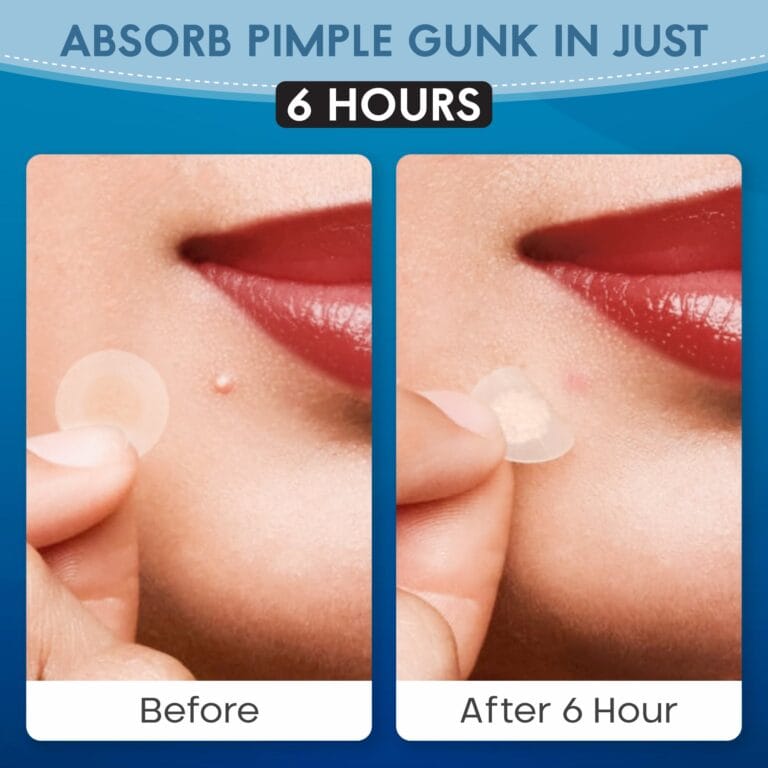 Before-and-after Zovira Invisible Pimple patch effectiveness, reduces blemish visibly in 6 hours. Ideal for acne-prone skin care.