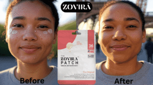 Zovira Patch packaging showcasing transformative skincare results with 36 patches for clear skin and zero stress.