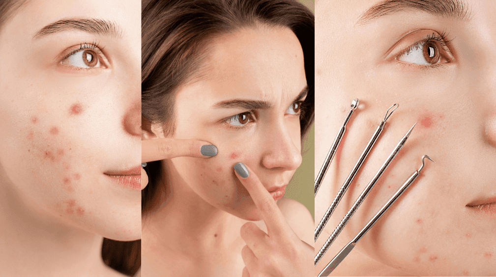 Close-ups of acne-prone skin, a woman inspecting her face, and skincare tools for pimple extraction.