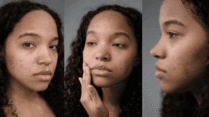 Close-up of a person's face with acne and curly hair, showing different angles and skin texture.